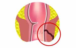 Figure 1 Anal fistula