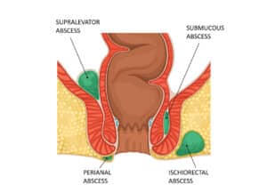 Figure 2 Anal abscess