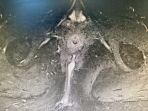 Figure 4 MRI